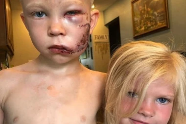 (FOTO) On je dečak SUPERHEROJ: Stao je ispred psa koji je krenuo na njegovu sestru i preživeo UŽAS! Njegove reči teraju suze na oči