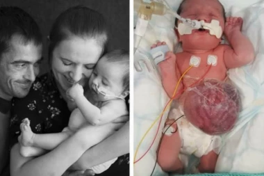 Devojčica (2) živi sa želucem, crevima i jetrom van tela: Roditeljima je rečeno da je najbolje da prekinu trudnoću, ali oni nisu želeli nikoga osim nje