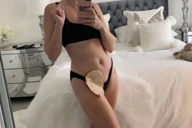 (ŠOK FOTO)  "Teško je ljudima objasniti da nemam rektum": Sa 12 godina dobila jezivu bolest, bilo je pitanje života ili smrti!