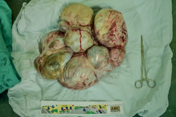 VODITE RAČUNA: Ovaj rak se otkriva u poodmakloj fazi, a godišnje od njega u Srbiji oboli bar 100 osoba