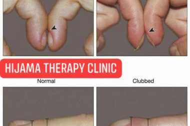 (FOTO) MOŽE VAM SPASITI ŽIVOT: OVAJ test od DVE sekunde otkriva da li bolujete od OPAKE bolesti!