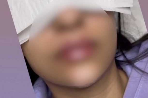 Prevara kakva nije zabeležena: Napunila usne u salonu, pa zbrisala puna hijalurona