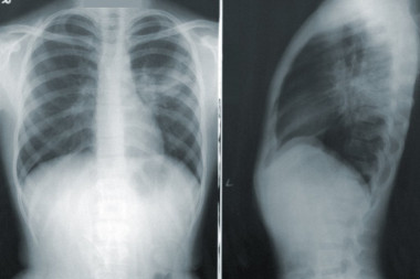 DUGI KOVID: Skrivena oštećenja pluća primećena na skeniranju, ovi pacijenti su u posebnom riziku