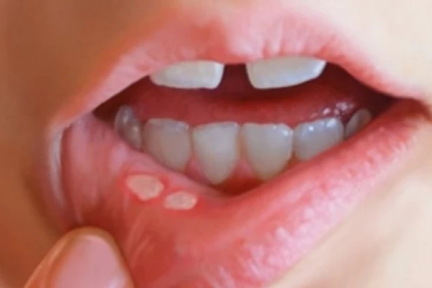 Bolne su, uporne i iritantne: Šta su AFTE i kako ih se na najbrži način otarasiti?