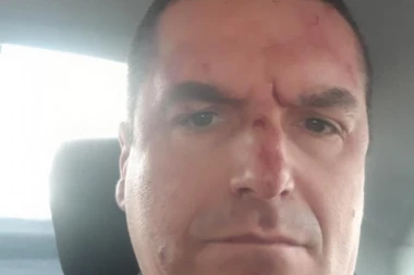 (FOTO) Oglasila se žrtva BRUTALNOG prebijanja u kafiću u Novom Pazaru: Mučki su nas izudarali, završio sam na skeneru