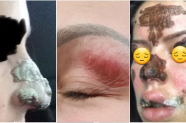 (FOTO) OVE ŽENE SU UNAKAŽENE U KOZMETIČKOM SALONU! Tvrde da im je koža spaljena i da imaju OŽILJKE od tretmana