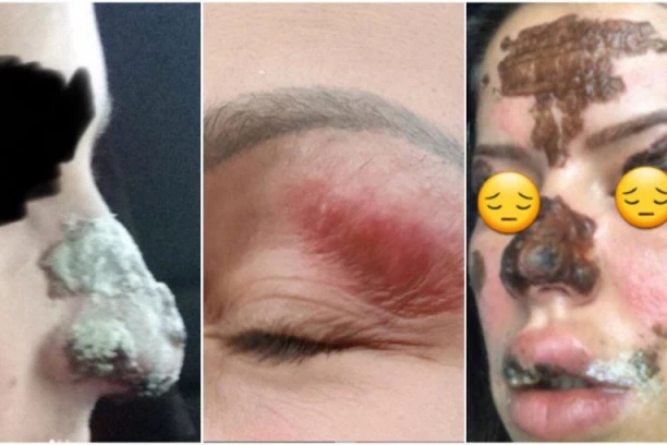 (FOTO) OVE ŽENE SU UNAKAŽENE U KOZMETIČKOM SALONU! Tvrde da im je koža spaljena i da imaju OŽILJKE od tretmana