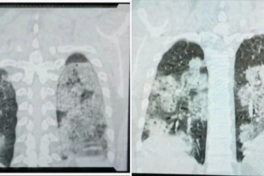 DOKTOR STEVANOVIĆ OBJAVIO SNIMAK PLUĆA PACIJENTA OBOLELOG OD KORONE! Za one koji ne znaju, zdrav je crni deo!