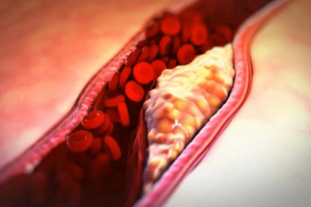 RUSKI KARDIOLOG RAZBIJA MIT DA LI JE MOGUĆE ČIŠĆENJE KRVNIH SUDOVA: Kako sprečiti i lečiti arteriosklerozu?