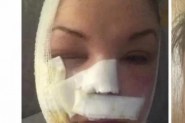 JAJE JOJ DOŠLO GLAVE: Isprobala trik za doručak sa televizije, pa umalo IZGUBILA ŽIVOT! ZAVRŠILA U ZAVOJIMA!