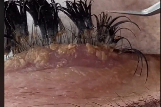 (VIDEO) UPOZORENJE ZA DEVOJKE: Ako ne čistite redovno nadograđene trepavice desiće vam se OVO!