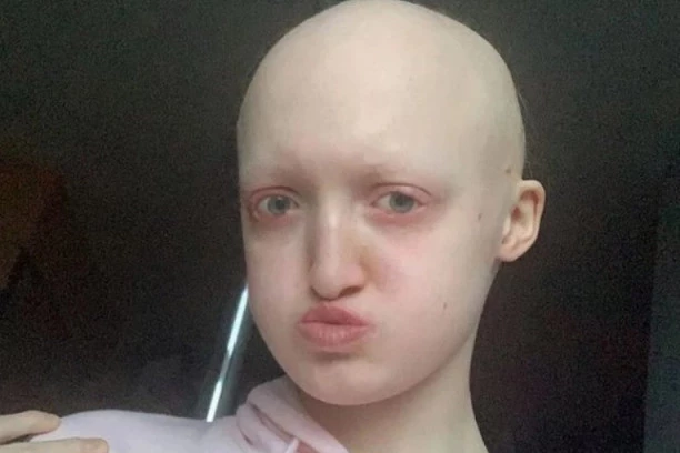 Hanu ceo život maltretiraju zbog bolesti: Vređaju me jer sam ćelava, a jedan dečak je pljuvao po meni! Htela sam da se ubijem