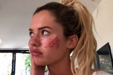 RIJALITI ZVEZDA UNAKAŽENA ZBOG LAŽNOG TRETMANA: Završila sam u bolnici s privremenim gubitkom vida, lice mi je NEPREPOZNATLJIVO