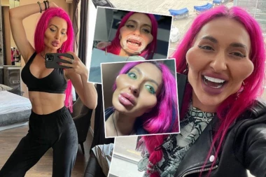 NOVA TRANSFORMACIJA! Sećate li se žene s najvećim jagodicama na svetu, pogledajte kako SADA IZGLEDA?!