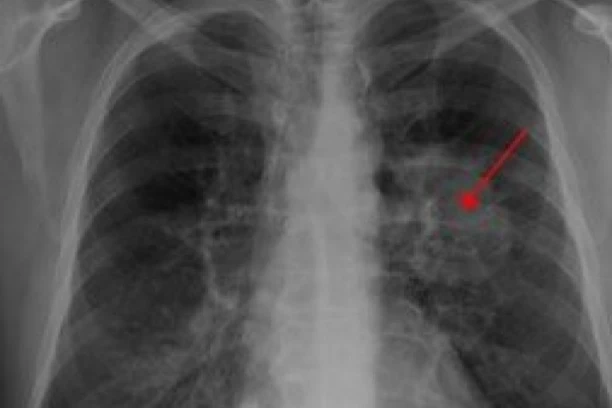 REVOLUCIJA: Veštačka inteligencija može RANIJE da otkrije rak pluća, evo i kako