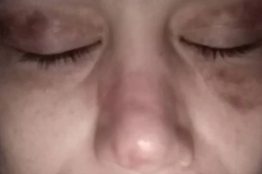 UHAPŠENA OLGICA MARKANOVIĆ: Lažna lekarka UNAKAZILA lica brojnih nesrećnih ljudi!