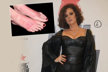 PEVAČICI IZGORELE NOGE: Slavica Ćukteraš zadobila opekotine po STOPALIMA!
