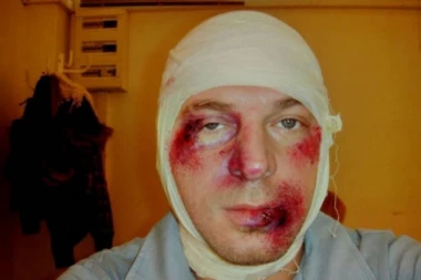 (FOTO) POPULARNI GLUMAC BRUTALNO PRETUČEN: Njegova supruga poludela je od BESA, pa dohvatila oklagiju! Razlog je BANALAN!