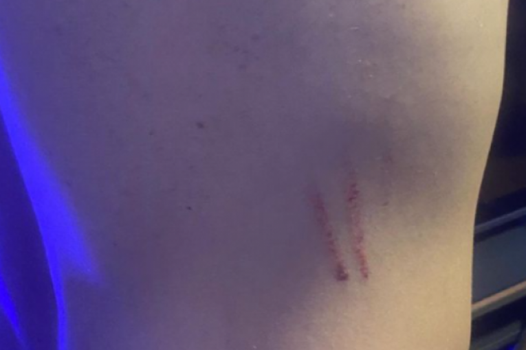 Ogrebotine po telu Nenada Aleksića Ša koje mu je napravila Tara tokom jedne svađe