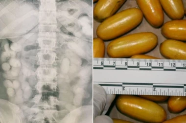 POGLEDAJTE KAKO IZGLEDA PUN STOMAK KOKAINA: Brazilka (28) pokušala da prokrijumčari drogu na Balkan