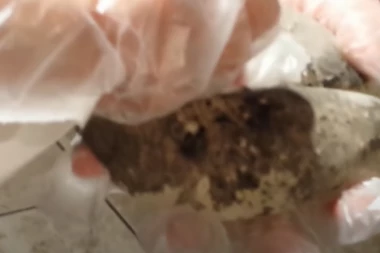 ZBOG SILIKONSKIH GRUDI UMALO OSTALA BEZ GLAVE! Ani telo iznenada počelo da se raspada, izgubila je vid i moć govora, a kad su je lekari otvorili ŽELUDAC IM SE OKRENUO! (VIDEO)