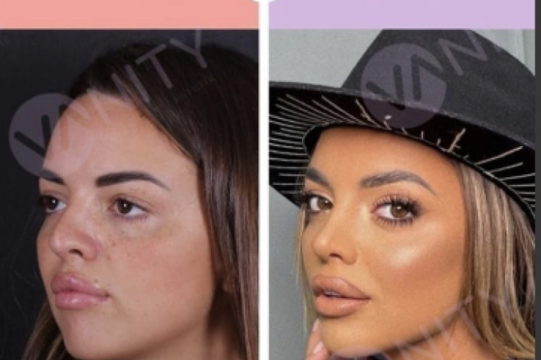 Sofija Šašić pre operacije i posle