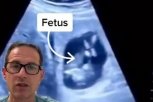 ŽENI U JETRI PRONAŠLI BEBU! Lekari u šoku: Otkriven najređi slučaj vanmaterične trudnoće na svetu, SVE SE VIDI NA SNIMKU! (VIDEO)
