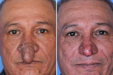 NAJVEĆI NOS NA SVETU U OBLIKU POLNOG ORGANA! Ovaj čovek ima anomaliju zbog koje ljudi BEŽE od njega (FOTO)