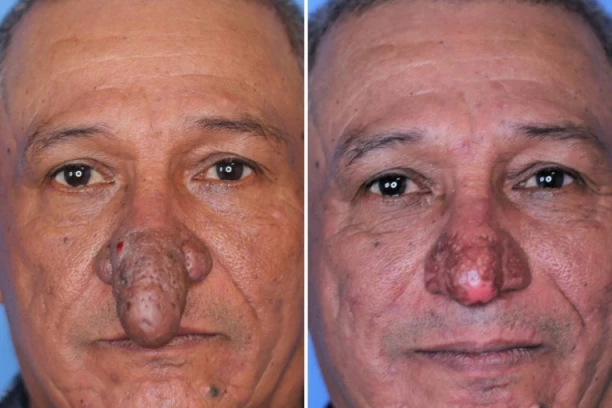 NAJVEĆI NOS NA SVETU U OBLIKU POLNOG ORGANA! Ovaj čovek ima anomaliju zbog koje ljudi BEŽE od njega (FOTO)