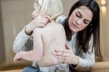 POTVRĐEN PRVI SLUČAJ MALIH BOGINJA U SRBIJI: Roditelji, vakcinišite decu!