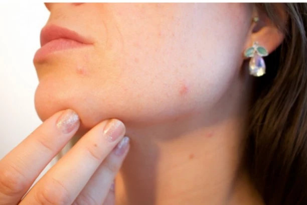 REŠITE SE BUBULJICA I AKNI ZAUVEK! Dermatolozi otkrivaju nekoliko ČUDESNIH TRIKOVA!