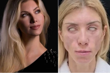 ZBOG PLASTIČNIH OPERACIJA VIŠE NE KONTROLIŠEM OČI: Nekada lepotica sada je unakažena: NE MOGU NI DA SE SMEJEM! (VIDEO)