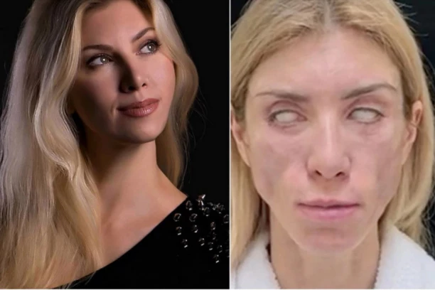 ZBOG PLASTIČNIH OPERACIJA VIŠE NE KONTROLIŠEM OČI: Nekada lepotica sada je unakažena: NE MOGU NI DA SE SMEJEM! (VIDEO)