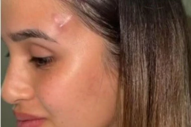 HTELA DA BUDE MAČKA, A POSTALA KOZA: Devojka nakon plastične operacije umesto lepših očiju dobila - ROGOVE! (VIDEO)
