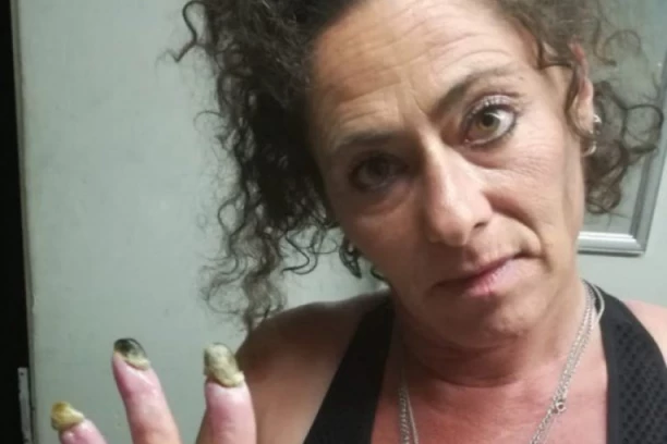 "PRSTI SU MI ODJEDNOM POCRNELI, ZAMALO DA OTPADNU"! Pogledajte JEZIVE slike i šta su cigarete uradile ovoj ŽENI (FOTO)