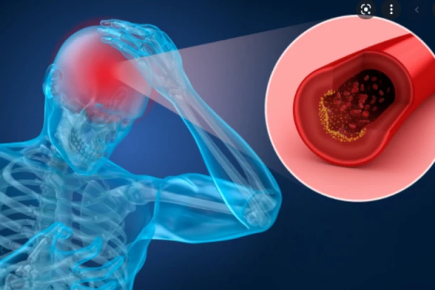 JEFTIN i svima dostupan LEK sprečava MOŽDANI UDAR! Epohalno otkriće naučnika!