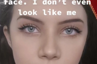 ESTETSKI HIRURZI JE UPROPASTILI: Ova lepotica je filere prvi put stavila sa 20 godina, sada joj se lice IZOBLIČILO! (VIDEO)