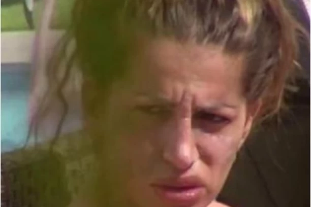 Šta se dešava sa licem Dalile Dragojević? PROMENE NA KOŽI aktuelne zadrugarke ŠOKIRAJU, evo OBJAŠNJENJA (FOTO)