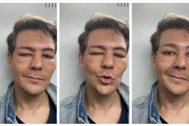 Milošu Bikoviću lice DEFORMISANO, glumac pokazao JEZIVO IZDANJE: Svi se pitaju šta mu se desilo? (VIDEO)