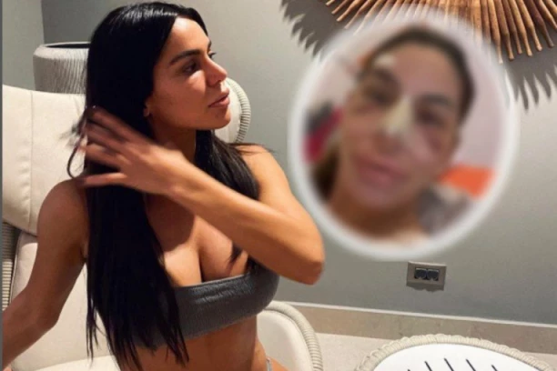 Naša pevačica završila na OPERACIJI, pojavila se fotka iz bolničkog kreveta: Masnice i podlivi svuda po licu, usne joj NABREKLE samo što ne puknu! (FOTO)