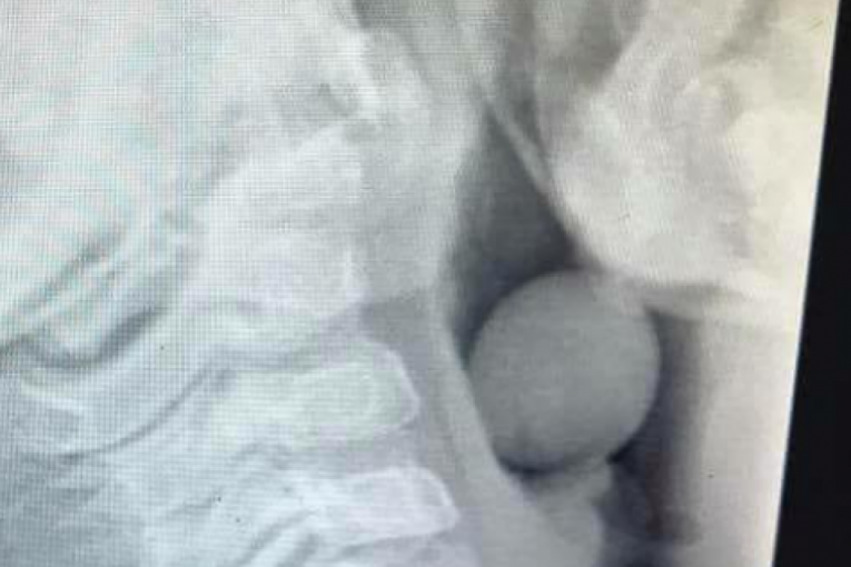 DEČAK ZAVRŠIO U HITNOJ: Šokantan rendgenski snimak pokazuje šta je progutao i počeo da se GUŠI! (FOTO)