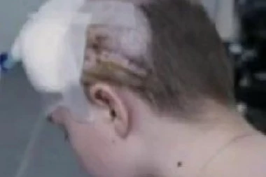 SAMO ČUDO JE SPASILO! Devojčici iz Ukrajine geler probio lobanju, zaustavio se usred mozga! (VIDEO)
