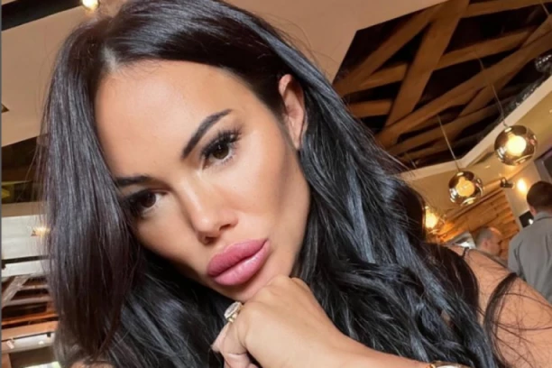 Tamara Đurić MODRA i u PODLIVIMA! Starleta ŠOKIRALA javnost, lice joj ljubičasto, modrice su svuda, evo šta joj se dogodilo! (FOTO)