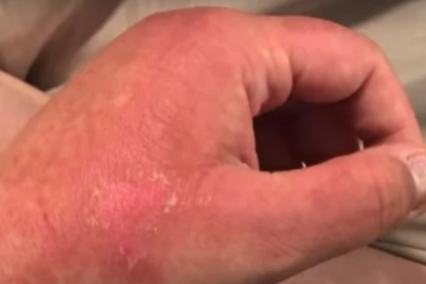 MAJKA NEUTEŠNA, DETE DOBILO OTVORENE RANE I OPEKOTINE PO LICU: Hoću da upozorim RODITELJE, samo je počela da GORI, za sve je krivo ovo VOĆE(VIDEO)