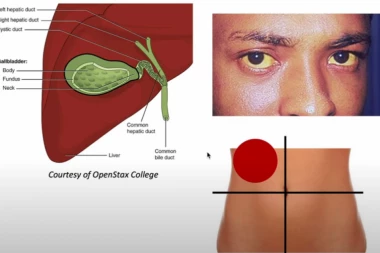 NEOČEKIVANO! Ovo je uzrok izbijanja Hepatitisa A! Pazite se!