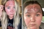 NAPRAVILA GREŠKU ZA KOJU MNOGI NE ZNAJU: Namazala kremu za sunčanje na lice, pa dobila opekotine drugog stepena (VIDEO)