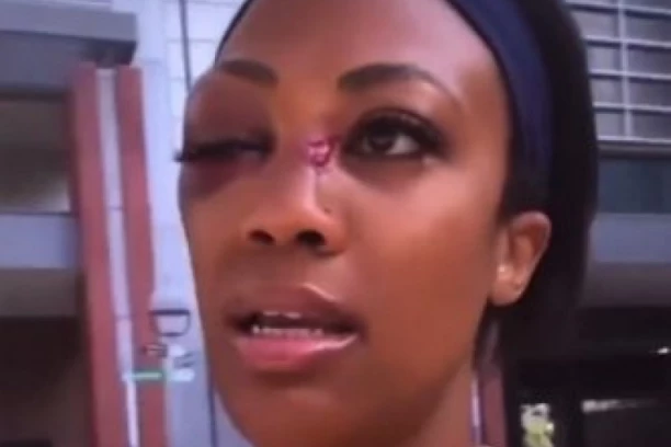 Brutalno: Jedna od najlepših odbojkašica sveta napadnuta na ulici, od povreda će se dugo oporavljati! (FOTO)