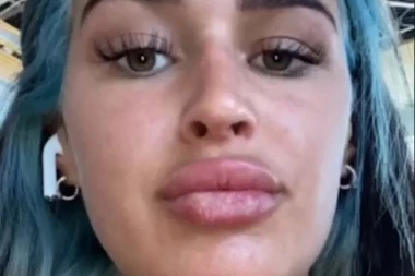 UNAKAŽENA SAM ZBOG SUNČANJA, do kraja života ću nositi masku! Potresne fotografije usana ove devojke obišle su svet, uradila je nešto što nikako nije smela!