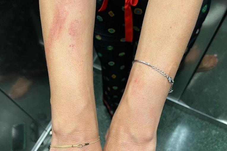 Severina nakon tuče sa sestrom