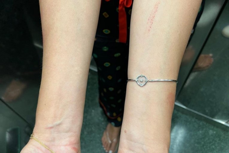 Severina nakon tuče sa sestrom